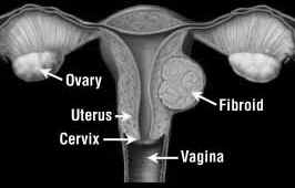Fibroids can develop on the inside or outside lining of your uterus or ...